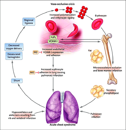 A-vicious-cycle-in-the-pathogenesis-of-acute-chest-syndrome-involving-red-cell